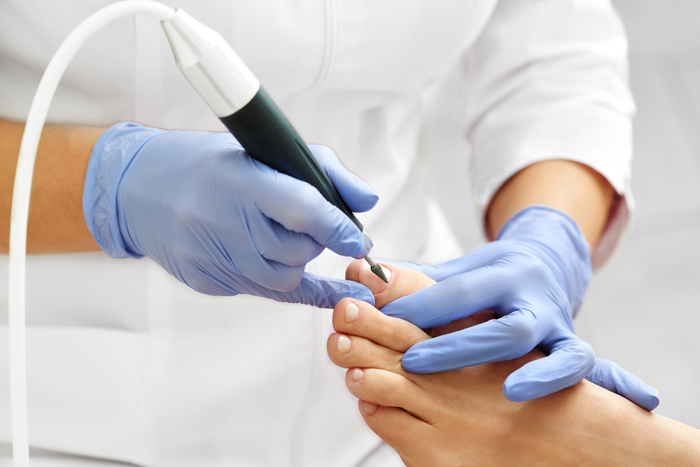 Fraisage d'un ongle d'orteil pour un podiatre
