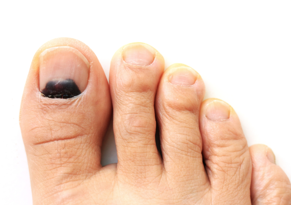 Présence d'un hématome sous l'ongle du gros orteil du pied droit