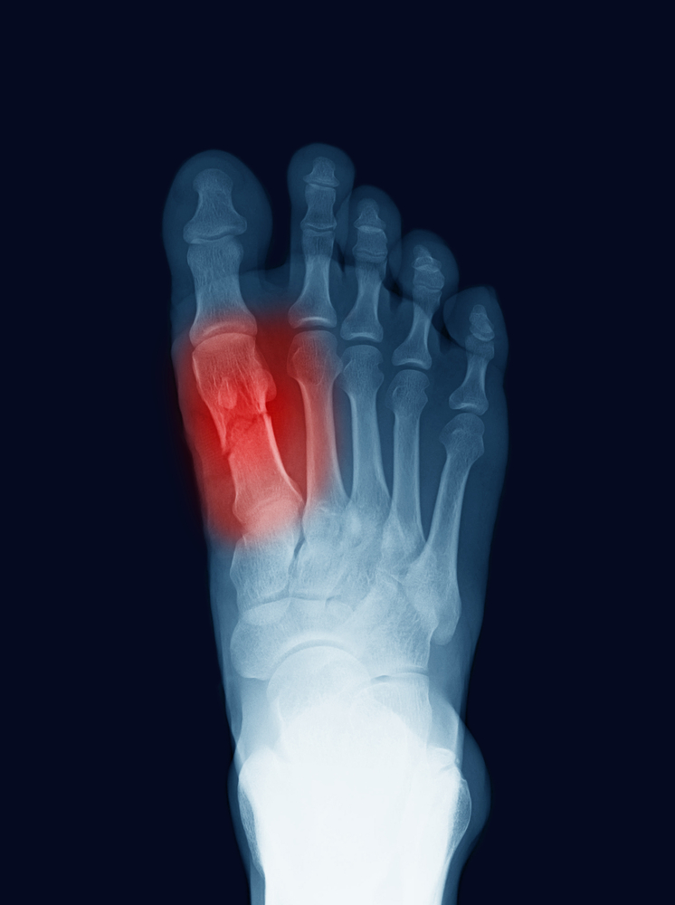 Fractures des pieds & chevilles Clinique Podiatrique SaintNicolas