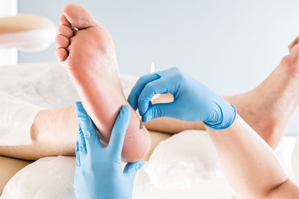 Podiatre qui fait un soin de pied en débridant la corne au talon avec un bistouri