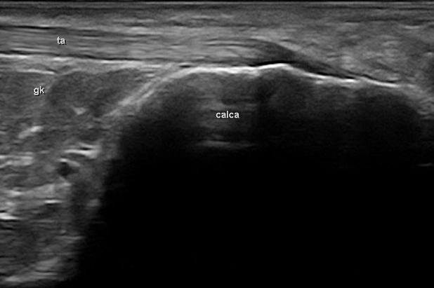 Échographie d'un tendon d'achille