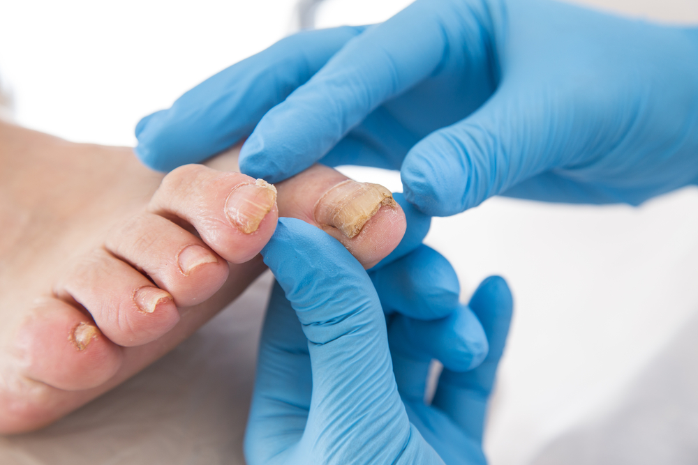 Évaluation d'un ongle mycotique par un podiatre